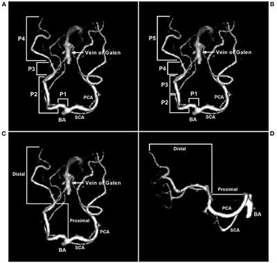 Endovascular Treatment of Posterior Cerebral Artery Trunk Aneurysm: The Status Quo and Dilemma